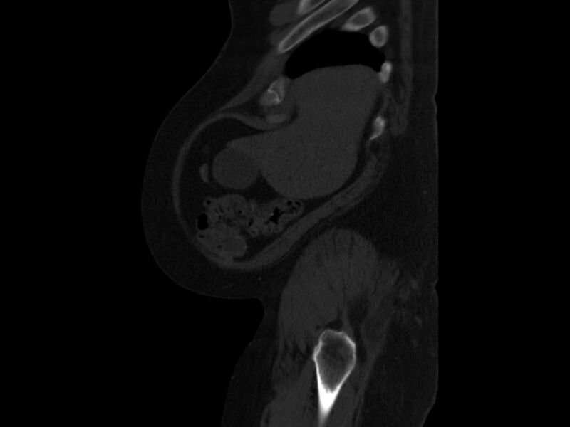 File:Ankylosing spondylitis (Radiopaedia 44609-48357 Sagittal bone window 2).jpg