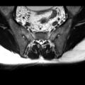 Ankylosing spondylitis with zygapophyseal arthritis (Radiopaedia 38433-40517 A 7).jpg