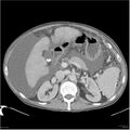 Annular pancreas and cirrhosis (Radiopaedia 24561-24843 A 3).jpg