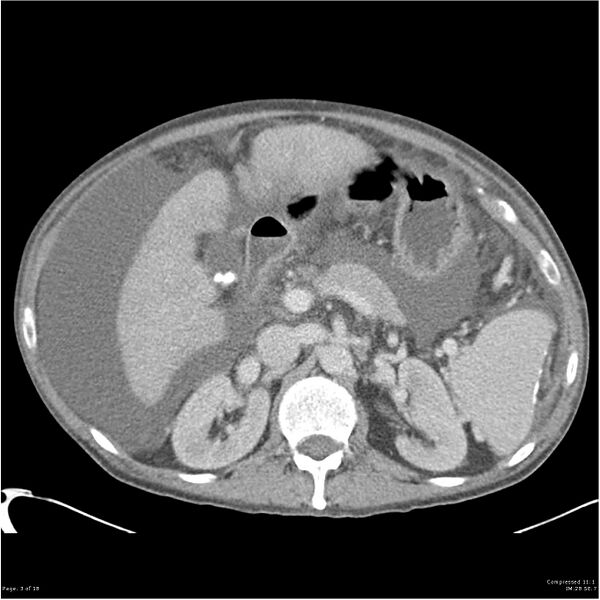 File:Annular pancreas and cirrhosis (Radiopaedia 24561-24843 A 3).jpg