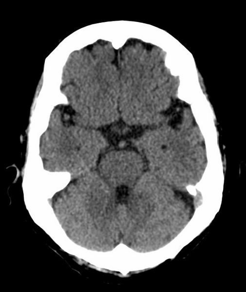 File:Anomalous intracranial venous drainage (Radiopaedia 28161-28418 Axial 37).png