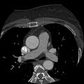 Anomalous origin of left circumflex artery from right coronary sinus (Radiopaedia 72563-83117 B 12).jpg