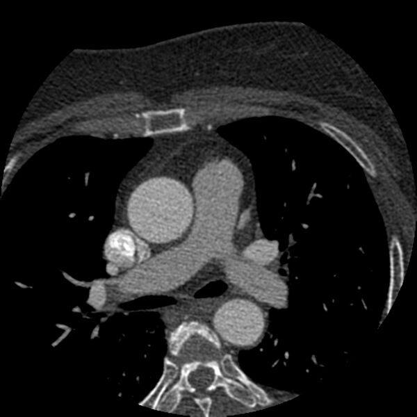 File:Anomalous origin of left circumflex artery from right coronary sinus (Radiopaedia 72563-83117 B 12).jpg