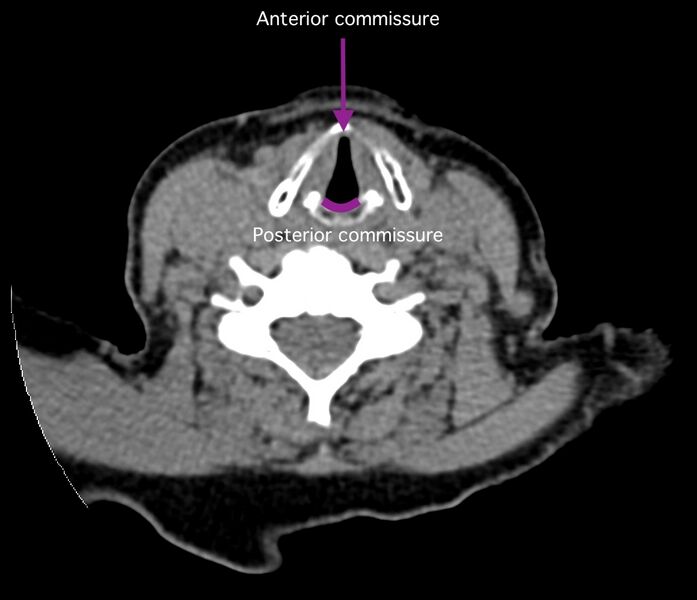 File:Anterior and posterior commissures of the larynx (diagrams) (Radiopaedia 61209-69115 A 1).jpeg