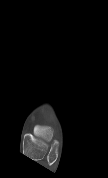 File:Anterior calcaneal process fracture (Radiopaedia 47384-51989 Axial bone window 7).png