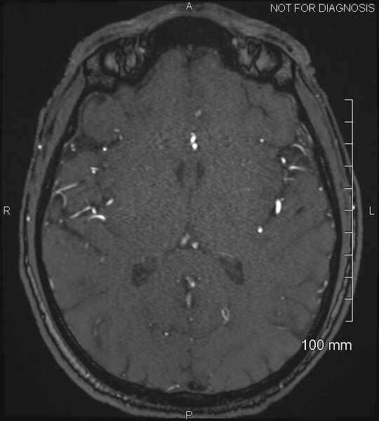 File:Anterior cerebral artery aneurysm (Radiopaedia 80683-94127 Axial MRA 133).jpg