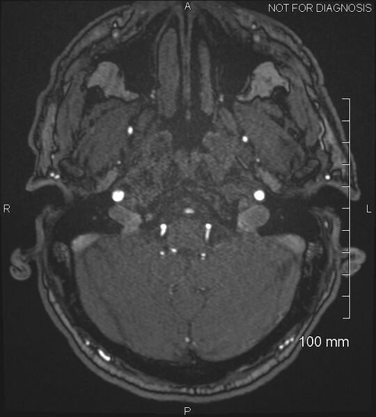 File:Anterior cerebral artery aneurysm (Radiopaedia 80683-94127 Axial MRA 31).jpg