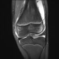 Anterior cruciate ligament tear - pediatric (Radiopaedia 62152-70260 Coronal PD fat sat 17).jpg