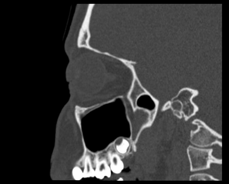 File:Antrochoanal polyp (Radiopaedia 21894-21868 Sagittal bone window 32).jpg