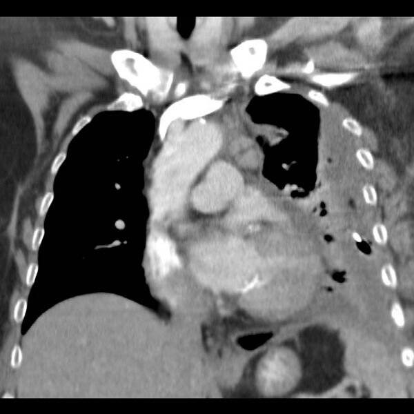 File:Aortic arch false aneurysm (Radiopaedia 14667-14588 B 3).jpg