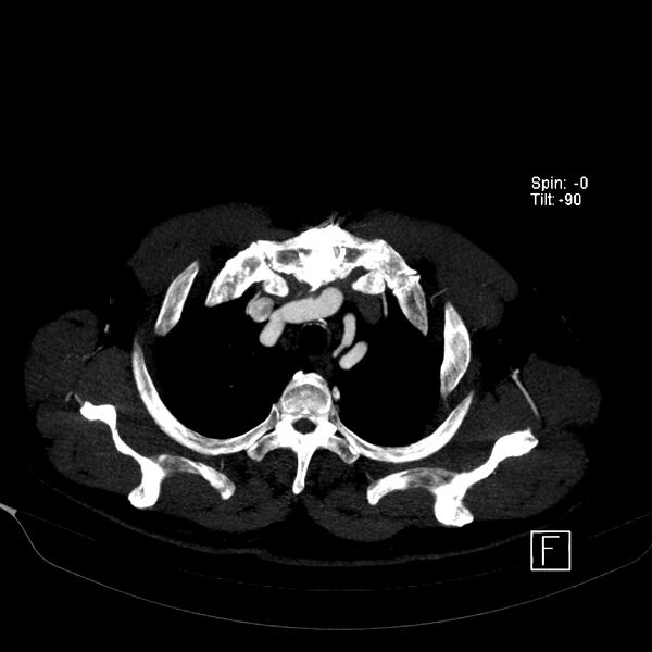 File:Aortic dissection - De Bakey type III - Stanford B (Radiopaedia 21903-21882 B 11).jpg