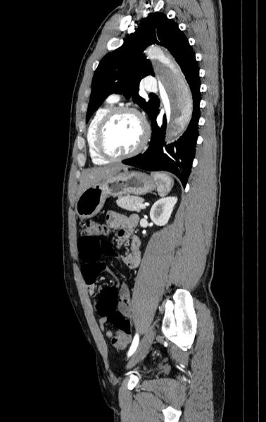 File:Aortic dissection - Stanford type A (Radiopaedia 83418-98500 B 62).jpg