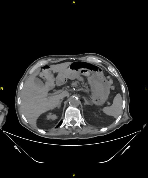 File:Aortoenteric fistula (Radiopaedia 84308-99603 Axial non-contrast 70).jpg