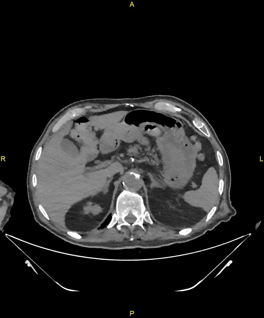 Aortoenteric fistula (Radiopaedia 84308-99603 Axial non-contrast 70).jpg