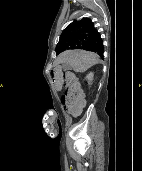 File:Aortoenteric fistula (Radiopaedia 84308-99603 C 71).jpg