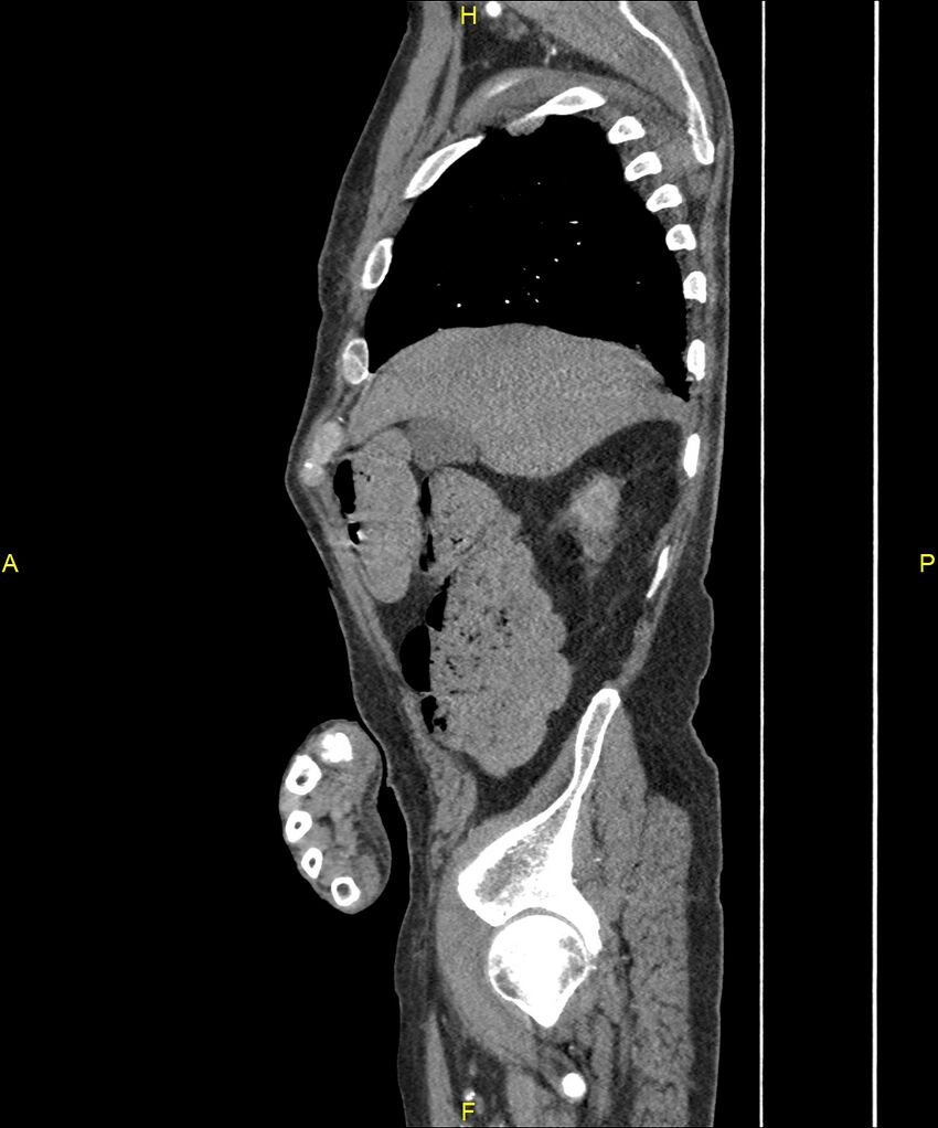 Aortoenteric fistula (Radiopaedia 84308-99603 C 71).jpg