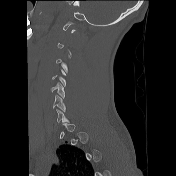File:Apical pneumothorax on cervical spine CT (Radiopaedia 45343-49368 Sagittal bone window 30).jpg