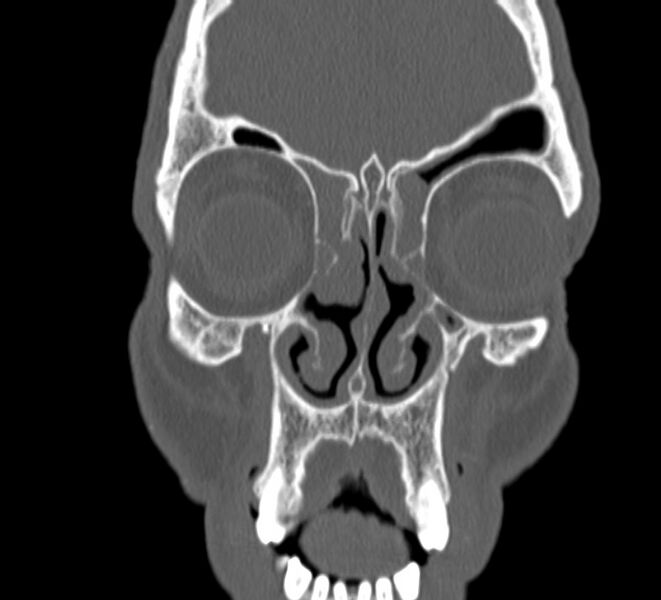 File:Aplastic maxillary sinuses (Radiopaedia 60030-67561 Coronal non-contrast 12).jpg