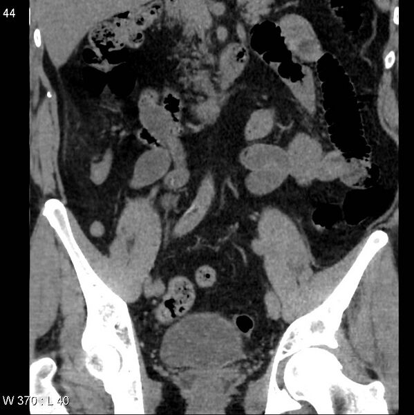 File:Appendicitis (Radiopaedia 12510-12733 Coronal non-contrast 14).jpg