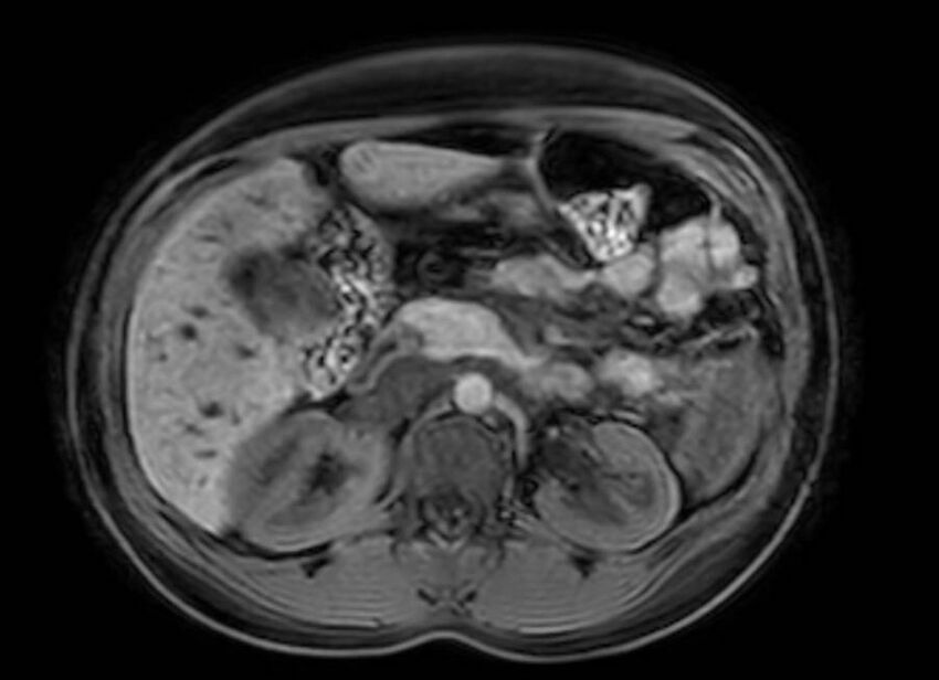 Appendicitis in gravida (MRI) (Radiopaedia 89433-106395 Axial DIXON 44).jpg