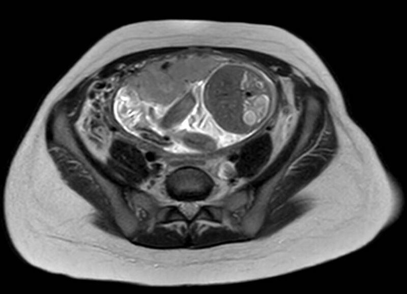 File:Appendicitis in gravida (MRI) (Radiopaedia 89433-106395 Axial T2 49).jpg