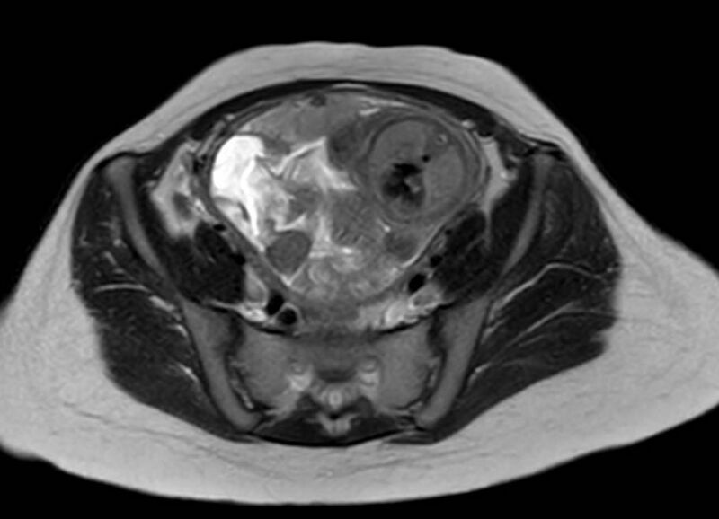 File:Appendicitis in gravida (MRI) (Radiopaedia 89433-106395 Axial T2 53).jpg