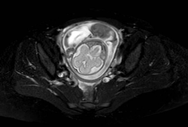 File:Appendicitis in gravida (MRI) (Radiopaedia 89433-106395 Axial T2 SPAIR 64).jpg