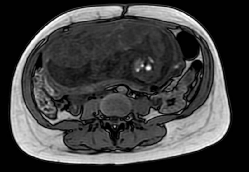 File:Appendicitis in gravida (MRI) (Radiopaedia 89433-106395 D 37).jpg