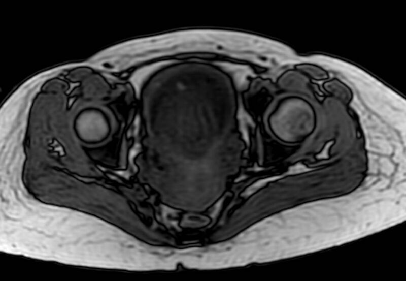 File:Appendicitis in gravida (MRI) (Radiopaedia 89433-106395 D 64).jpg