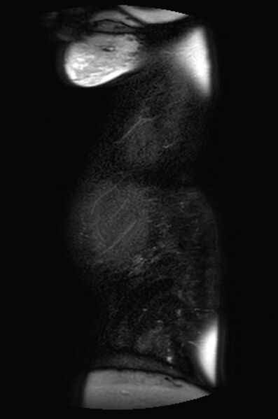 File:Appendicitis in gravida (MRI) (Radiopaedia 89433-106395 Sagittal T2 SPAIR 1).jpg