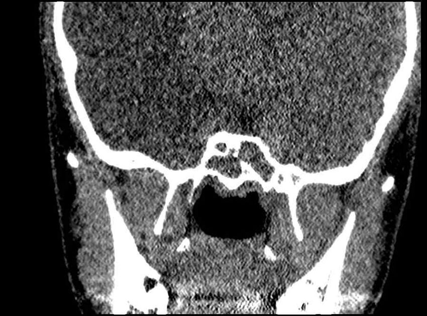 Arachnoid cyst- extremely large (Radiopaedia 68741-78450 Coronal bone window 16).jpg