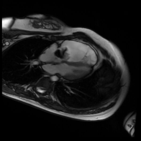 File:Arrhythmogenic right ventricular cardiomyopathy (Radiopaedia 87505-103850 4ch Cine SSFP 65).jpg