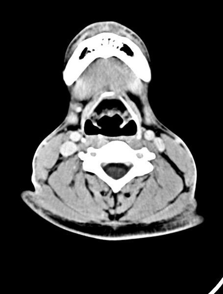 File:Arrow injury to the face (Radiopaedia 73267-84011 Axial C+ delayed 10).jpg