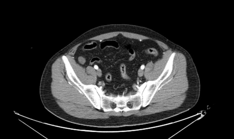 File:Arterial occlusive mesenteric ischemia (Radiopaedia 84641-100060 A 106).jpg