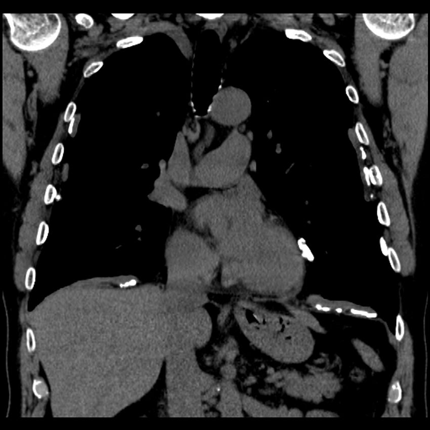 Asbestos-related pleural plaques (Radiopaedia 39069-41255 Coronal non-contrast 48).jpg