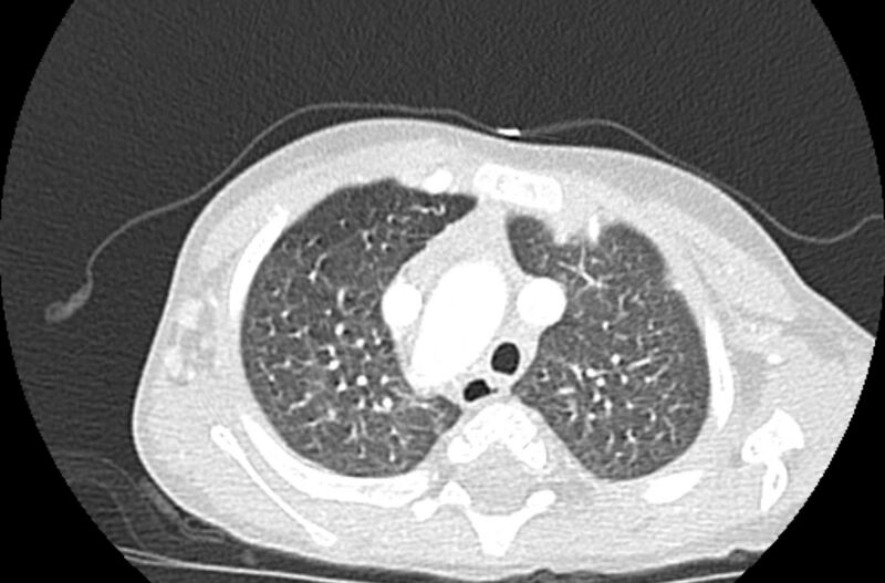 File:Asplenia syndrome (Radiopaedia 73083-83792 Axial lung window 15).jpg