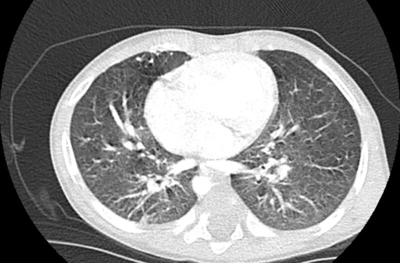 File:Asplenia syndrome (Radiopaedia 73083-83792 Axial lung window 42).jpg