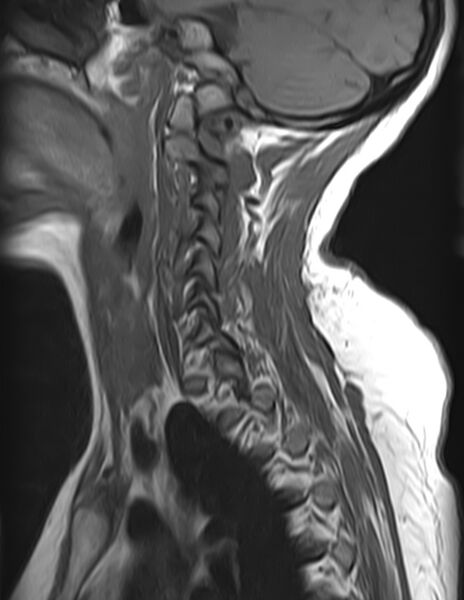 File:Astrocytoma - spinal cord (Radiopaedia 69769-79758 Sagittal T1 3).jpg