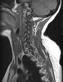 Astrocytoma - spinal cord (Radiopaedia 69769-79758 Sagittal T1 3).jpg