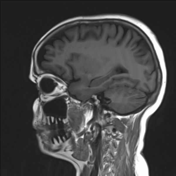 File:Atlanto-occipital assimilation with basilar invagination (Radiopaedia 70122-80157 Sagittal T1 7).jpg