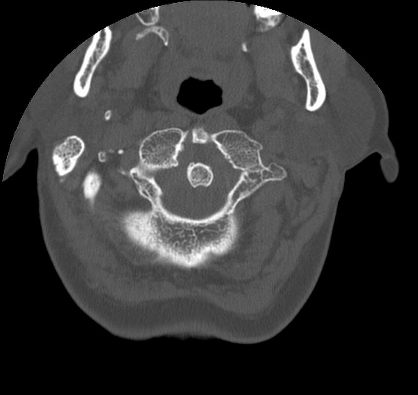 Atlanto-occipital assimilation with basilar invagination (Radiopaedia 70122-80188 Axial bone window 19).jpg