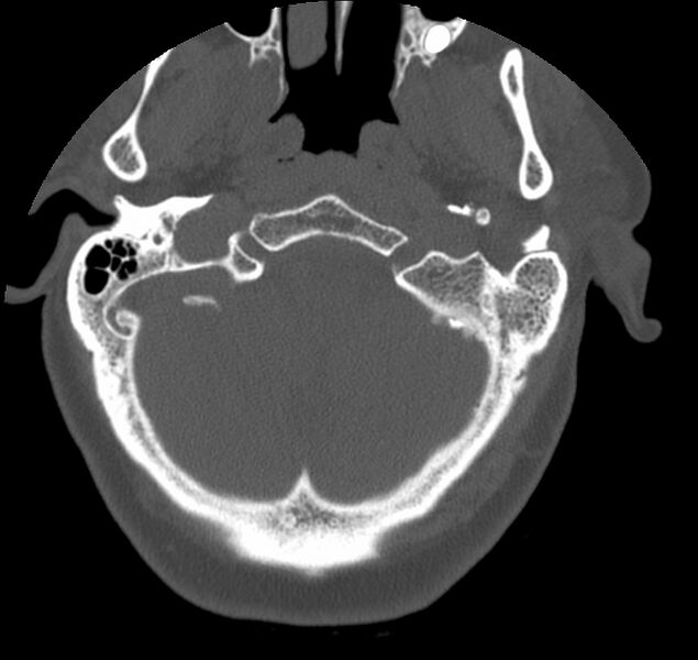 File:Atlanto-occipital assimilation with basilar invagination (Radiopaedia 70122-80188 Axial bone window 3).jpg