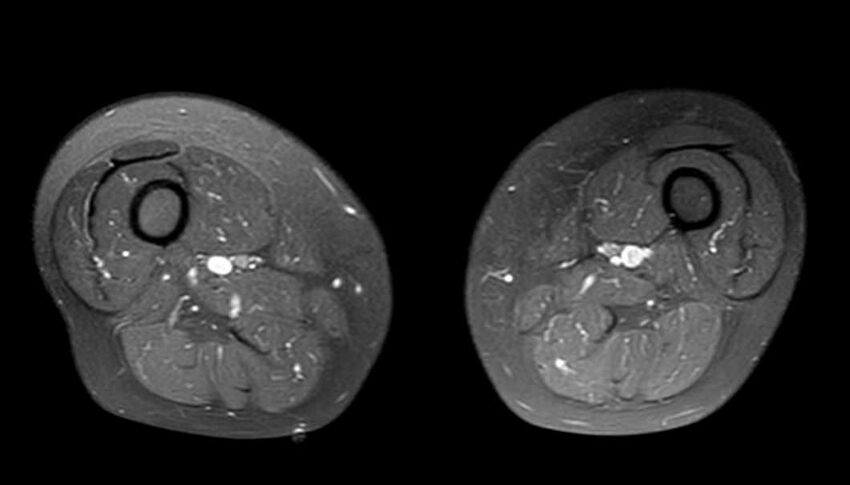 Atypical lipomatous tumor - thigh (Radiopaedia 68975-78734 Axial PD fat sat 41).jpg