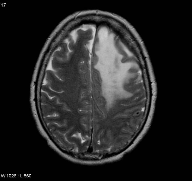 File:Atypical meningioma (WHO grade II) (Radiopaedia 5273-7016 Axial T2 10).jpg