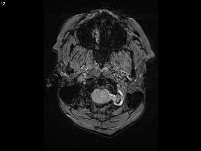 Atypical meningioma - intraosseous (Radiopaedia 64915-74572 Axial SWI 12).jpg