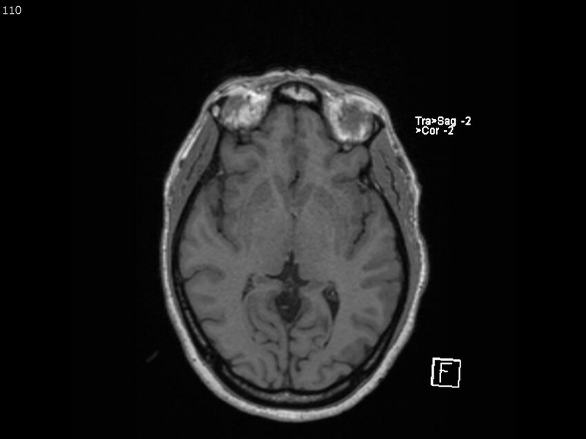 Atypical meningioma - intraosseous (Radiopaedia 64915-74572 Axial T1 110).jpg