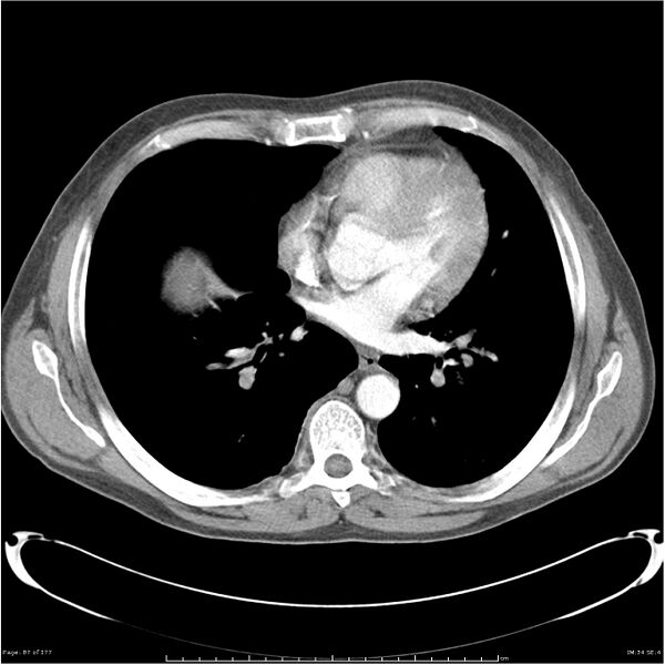 File:Atypical pneumonia - Q fever (Radiopaedia 21993-21989 C+ arterial phase 29).jpg