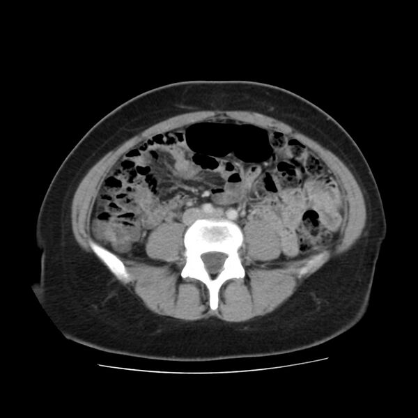 File:Autosomal dominant polycystic kidney disease (Radiopaedia 23061-23093 C 43).jpg