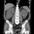 Autosomal dominant polycystic kidney disease (Radiopaedia 36539-38101 C 46).jpg