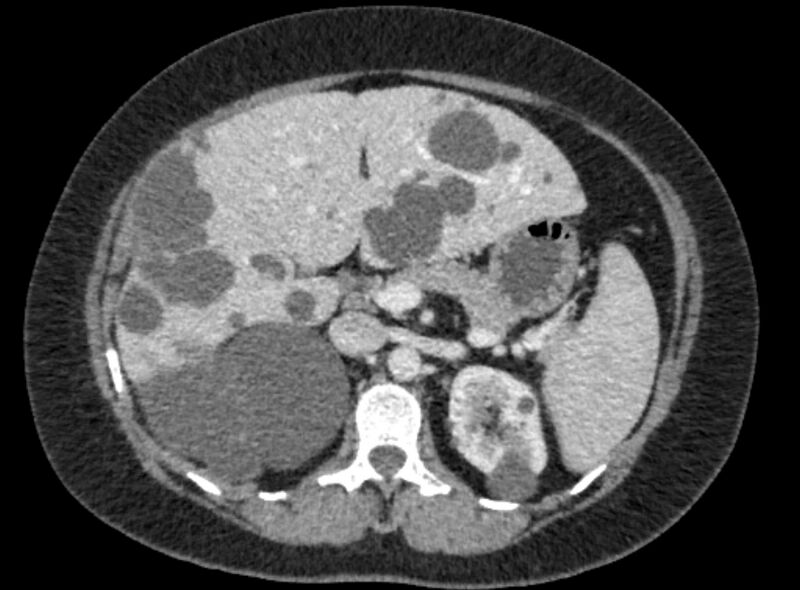 File:Autosomal dominant polycystic kidney disease (Radiopaedia 57124-64017 A 44).jpg